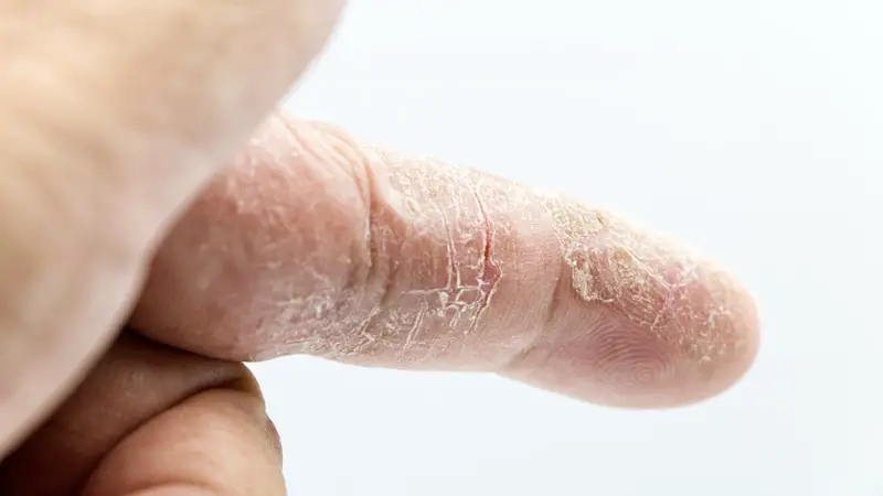 Up-close picture of an adult with eczema on his finger. The dermatitis is cracked and flaking skin.