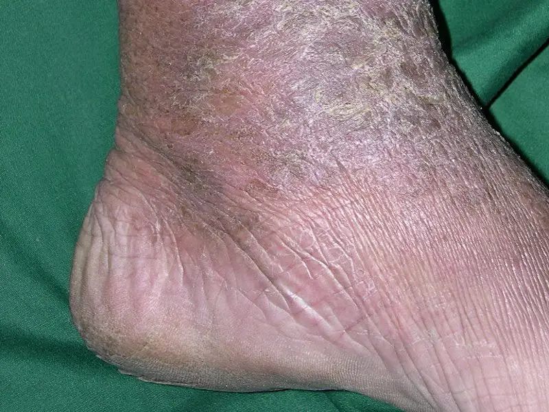 An adult left foot and leg with severe dry and cracked skin all the way up the calf.