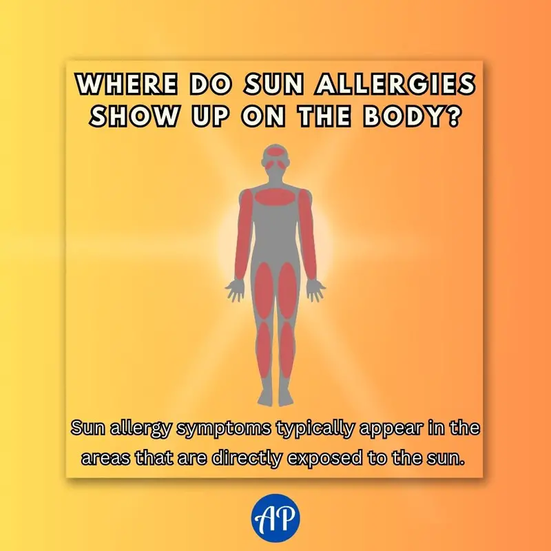Where do sun allergies show up on the body infographic. Sun allergy symptoms typically appear in the areas that are directly exposed to the sun: Face, arms, legs, back, and neck.
