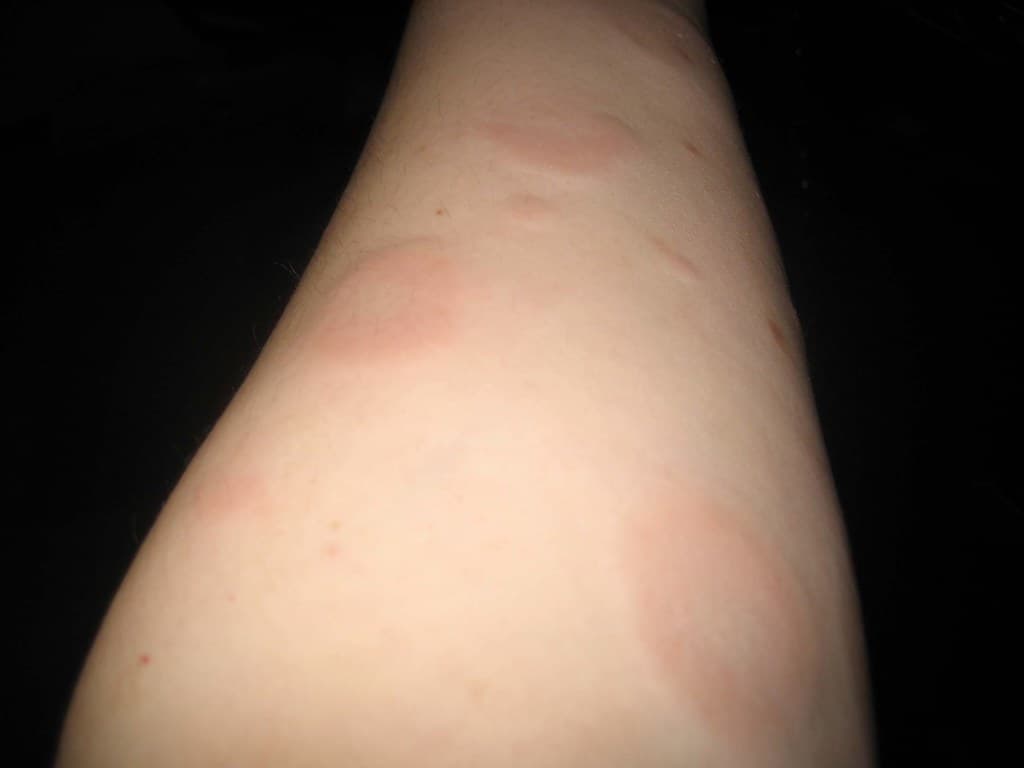 round, red hives on arm