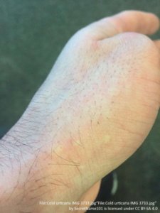 cold urticaria on left hand near thumb from exposure to cold air. The hives are kind of hard to see and almost look white.  