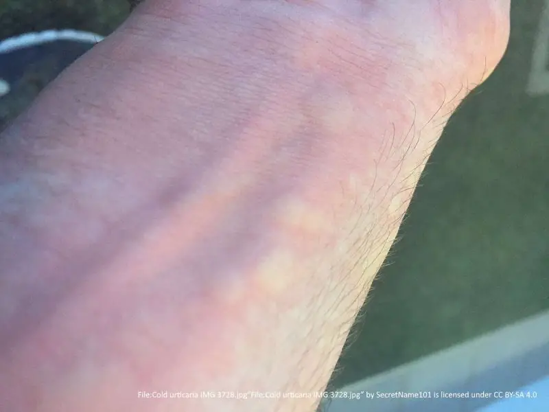 hives on the underside of wrist, white blotchy hives with red skin surrounding.