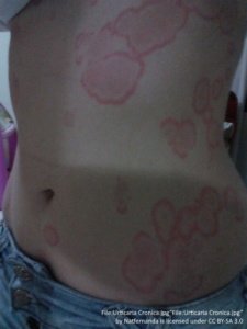 large, red blotches of hives on hips, stomach and chest. 