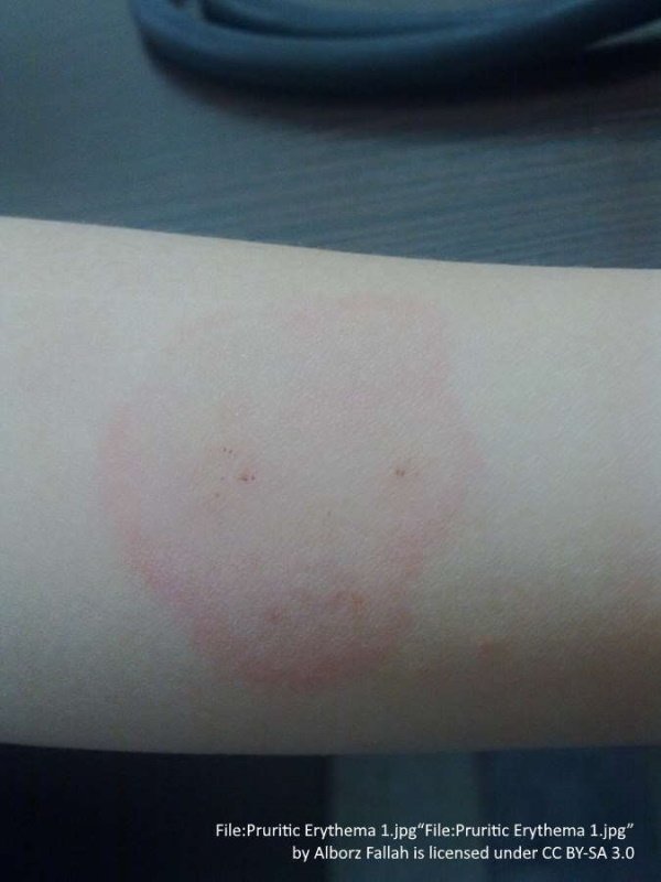 pruritic erythema on forearm. one red blotch with two dots inside. 