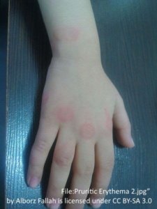 round red patches of hives on right hand skin, over knuckles and fingers. showing allergic reaction wheals