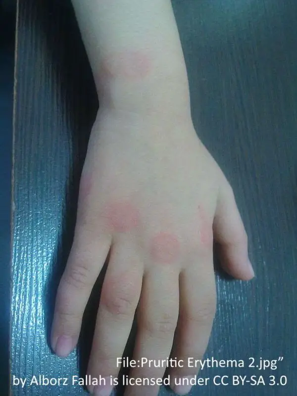 round red patches of hives on right hand skin, over knuckles and fingers. showing allergic reaction wheals