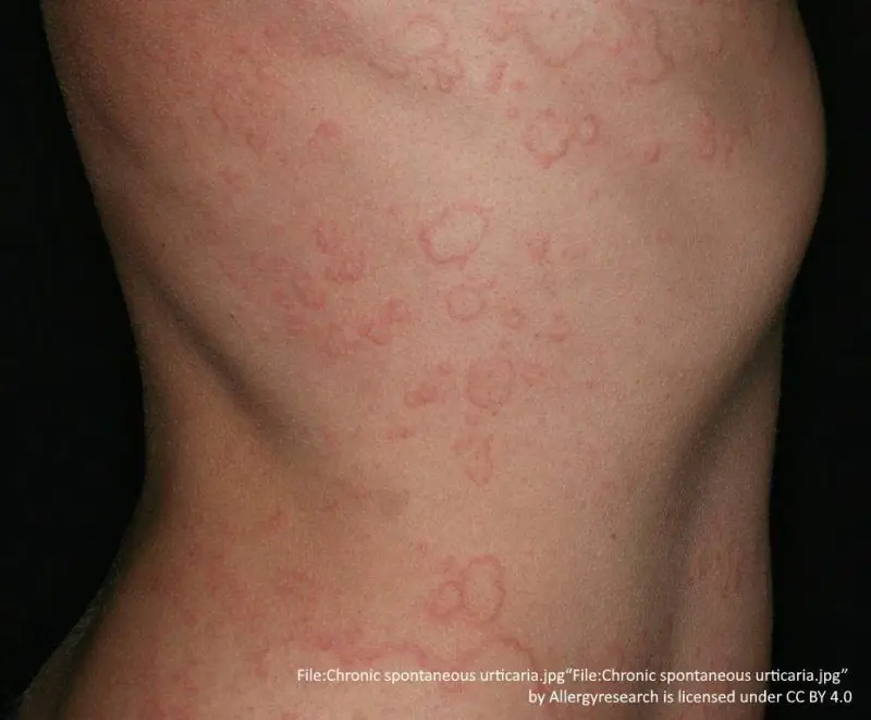 chronic spontaneous urticaria on the chest and abdomen