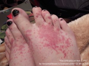 dark red rash of hives on the right foot. rash is mostly on the top of the foot with a few hives going to each toe. 