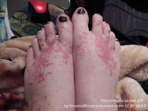 both feet showing dark red hives. The left foot has more spread out urticaria versus the right foot
