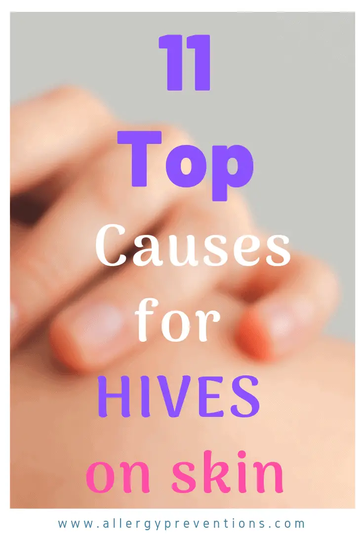 11 top causes for hives on skin allergy preventions