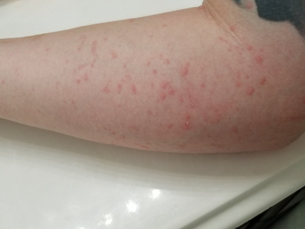 hives on my arm Allergy Preventions