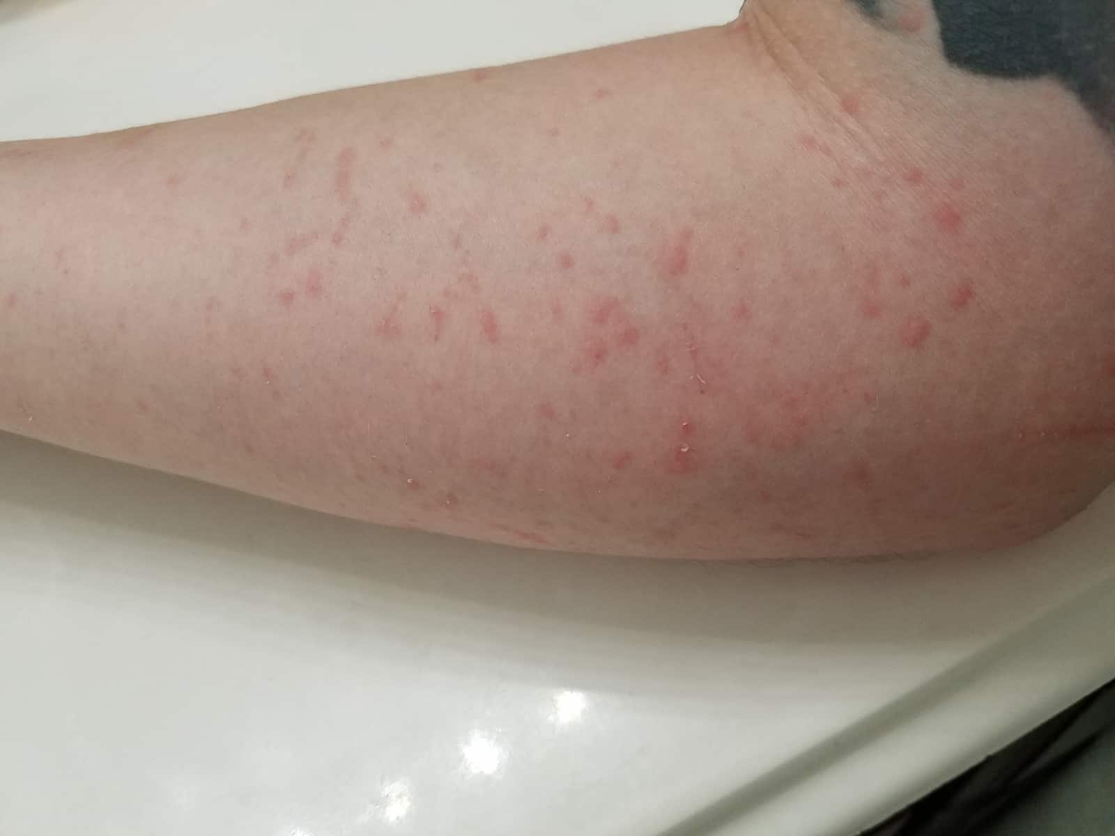 Itchy Hives On Arms