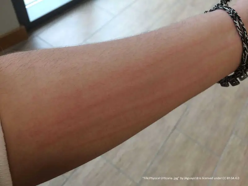 physical urticaria on forearm showing lines of scratches with raised welts.