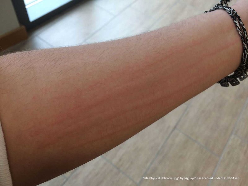 physical urticaria on forearm showing lines of scratches with raised welts. 