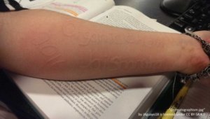 physical urticaria dermatographism on the forearm with writing that says "organic chem 2016". The writing looks raised and inflamed from "skin writing". 