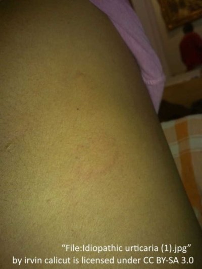 37 Detailed Pictures of Hives on Skin - Allergy Preventions
