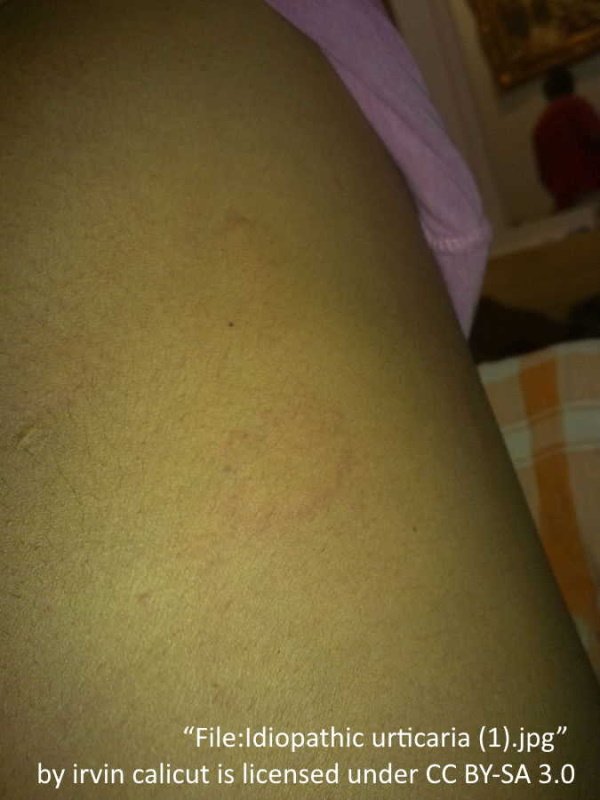 chronic idiopathic urticaria on skin showing a few hives and welts with a circle pattern. 