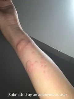 very swollen wheals under the arm with raised hives from allergies.