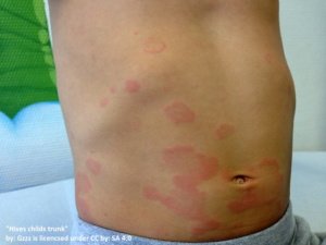 hives on the trunk, belly button, and back, caused by acute viral urticaria. 