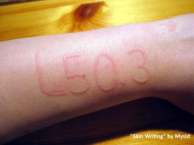 dermatographic urticaria or skin writing. using a ball point pen on the arm, it reads "L50.3" The swelling is only where the person wrote on their arm and did not cause any swelling outside of that area. 