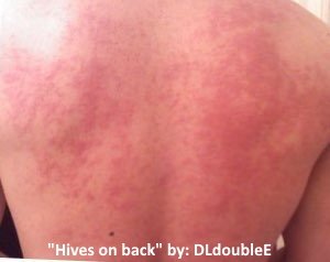 hives covering the entire back and shoulders with raised patches. caused by and allergic reaction. The hives are blotchy and a deep red color all over the skin of the back. 