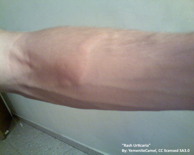 forearm with a rash and welt from an allergic reaction. The hives are not red, but swelling is present. 
