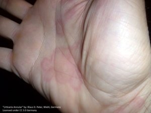 annular urticaria on the palm of the hand. the lesions were described as itchy, and have an unknown cause. 