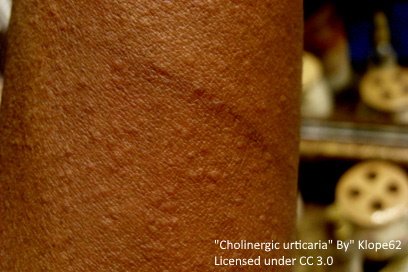 cholinergic urticaria on the trunk, with lots of tiny raised dots. Also called heat bumps or sweat bumps.