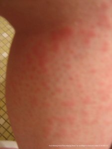 hives on legs after getting a wax treatment. many small hives on the skin, all over leg that resemble razor bumps. 
