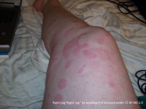 different shaped wheals of hives on the leg from the thigh down to the calf.