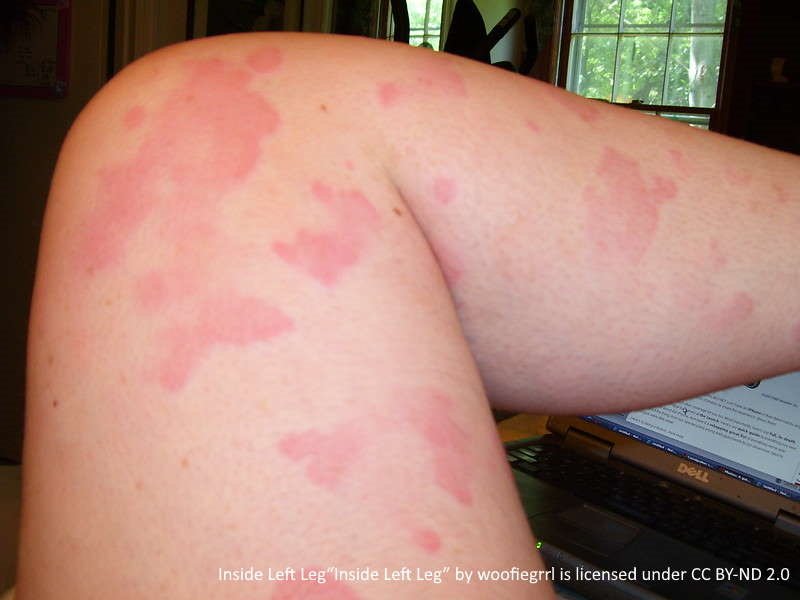 leg welts from hives with a red blotchy appearance. These hives are on the skin starting at the upper thigh and continue down the calf muscle. 