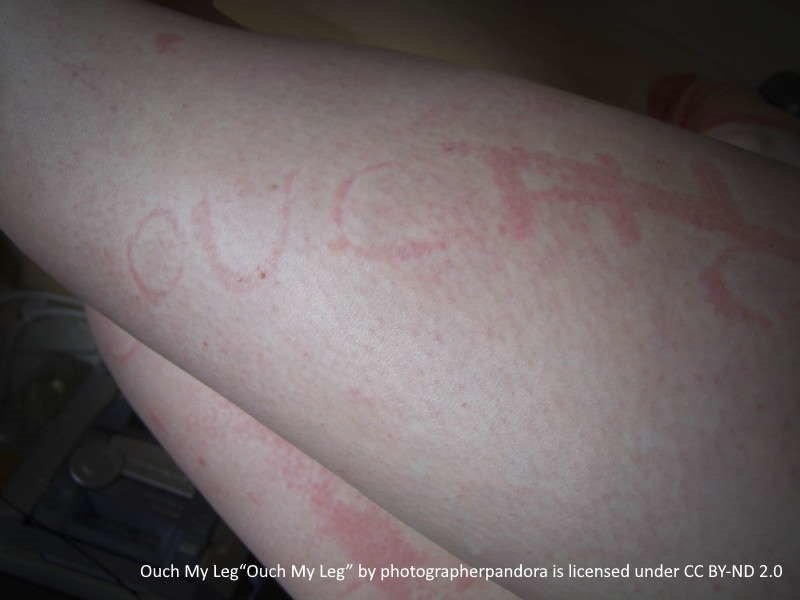 urticaria deratographism, skin writing, and says "ouch"