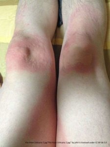swollen hives on both knees, really red and rashy