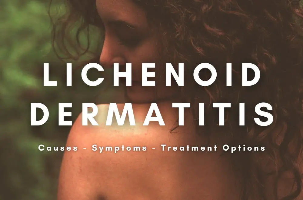 Lichenoid Dermatitis-causes, symptoms, treatment options