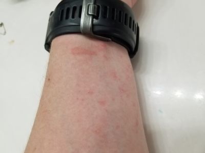 Allergy hives on arm near wrist from grass and pollen exposure while mowing the lawn. These hives are smaller and not very inflamed. There is also one welt near the wrist. 