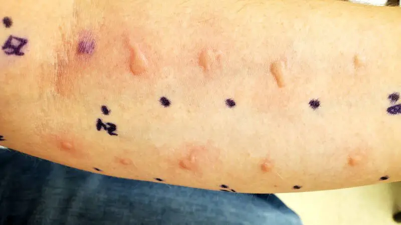 allergy-testing-wheals-allergy-preventions-allergic reaction on my arm from allergy testing with 9 welts visible