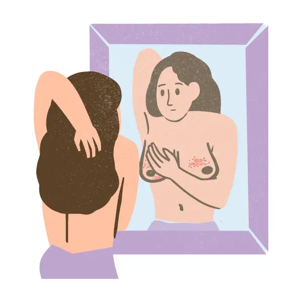 cartoon breast eczema infographic of a woman looking in the mirror. Her breasts show signs of dermatitis. Art by allergypreventions