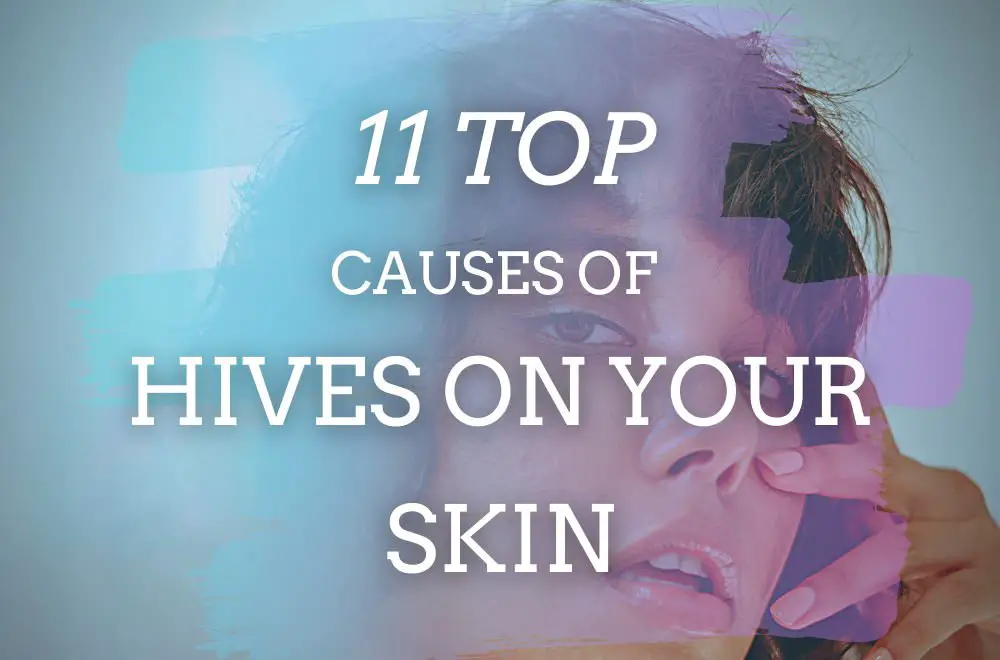 11 Top Causes for Hives on Skin