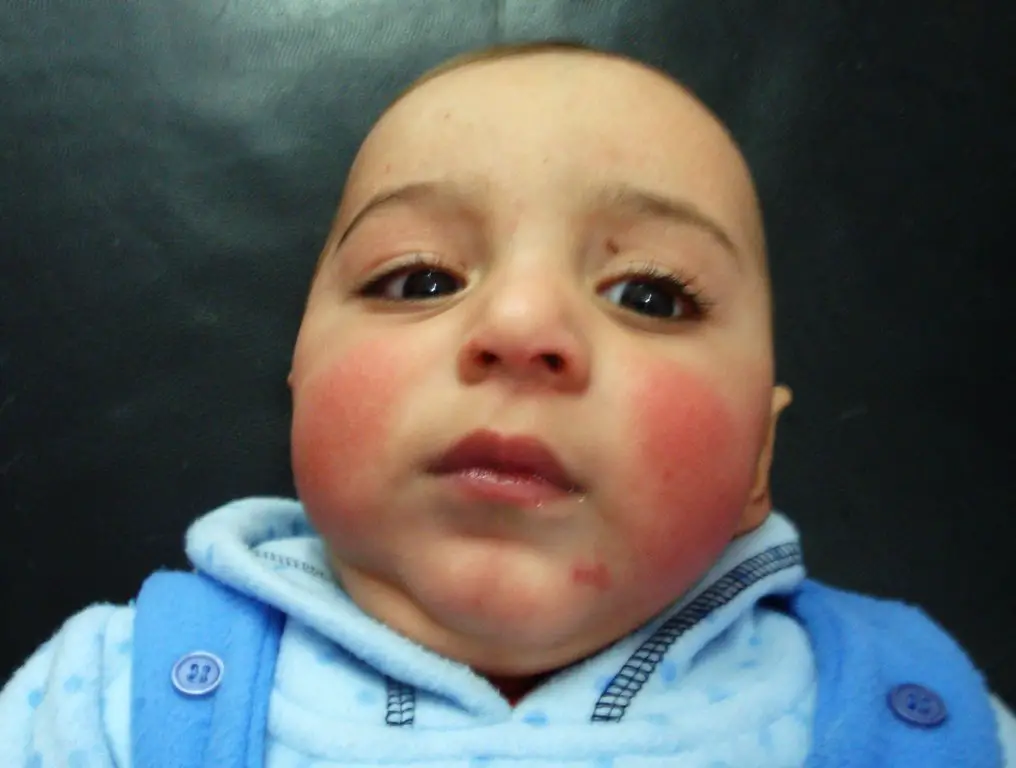 Image of a baby boy with red and scaly cheeks. Possible CMPA, cow's milk protein allergy.