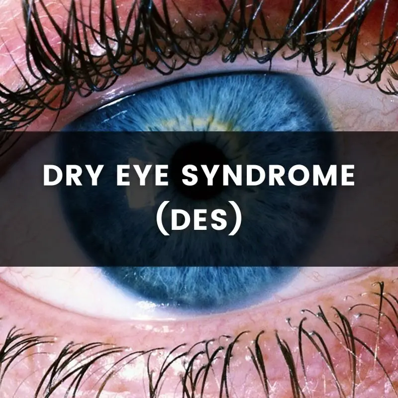 close-up image of a very blue eyeball. Text over the image says "Dry Eye Syndrome (DES)"