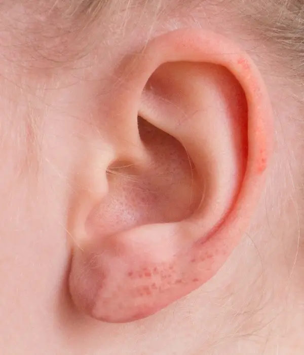 ear eczema with redness and swelling on the bottom lobe and up the outside of the ear. 