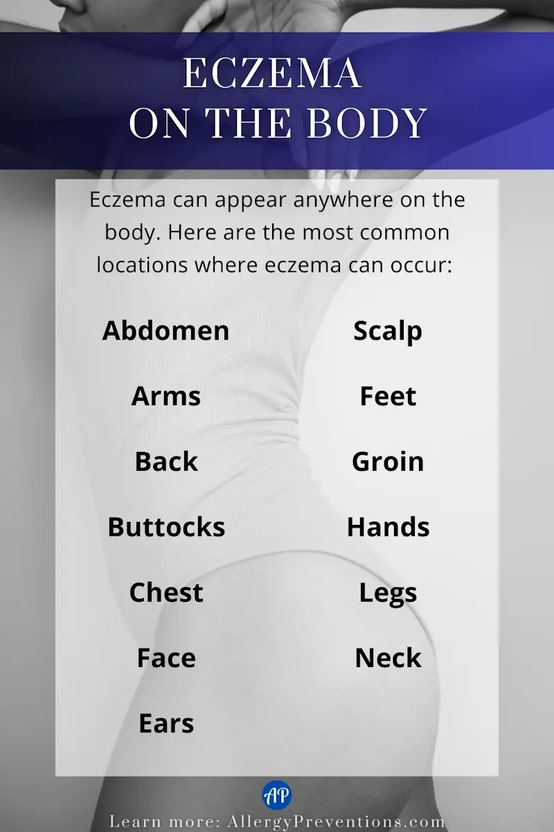 Eczema on the body infographic. Eczema can appear anywhere on the body, here are the most common locations where eczema can occur: Abdomen, arms, back, buttocks, chest, face, ears, scalp, feet, groin, hands, legs, and neck.