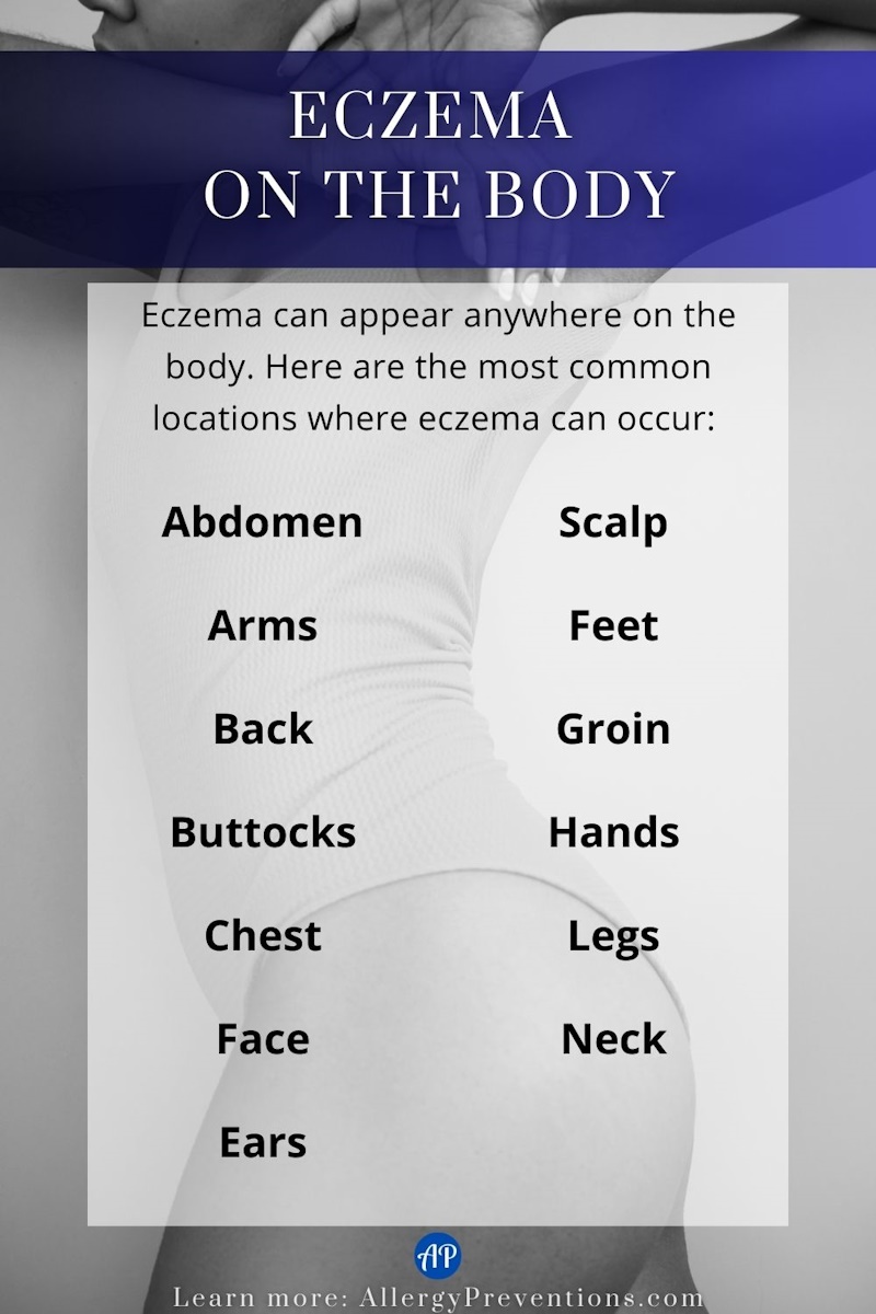 Eczema on the body infographic. Eczema can appear anywhere on the body, here are the most common locations where eczema can occur: Abdomen, arms, back, buttocks, chest, face, ears, scalp, feet, groin, hands, legs, and neck.