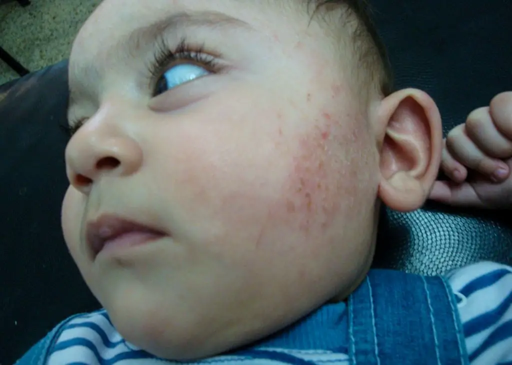 Image of a baby's left cheek with excoriated dermatitis. Possible cause of rash on face is CMPA.