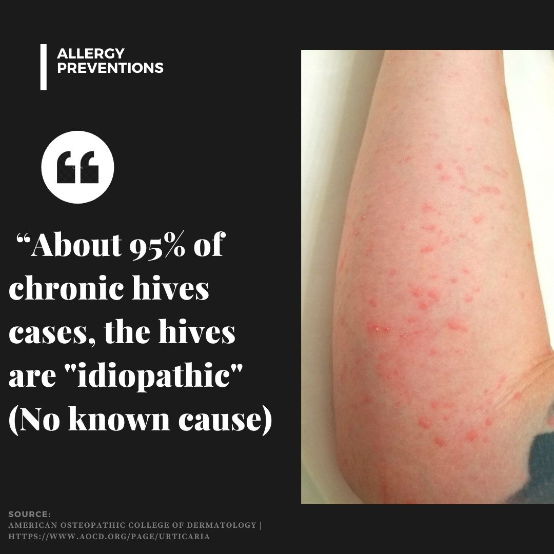 hives-causes-idiopathic infographic. fact: almost 95% of chronic hives cases, the hives are "idiopathic" (no known cause)