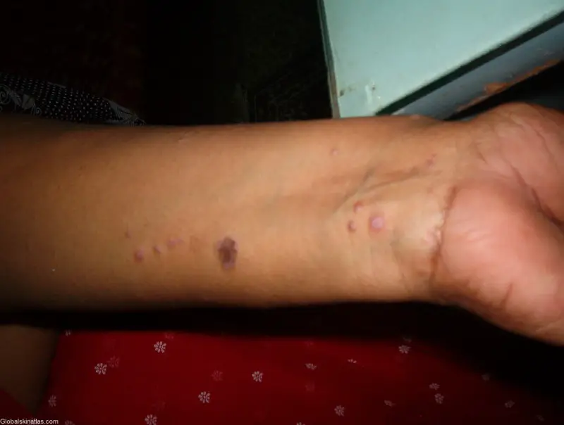 Lichen Planus (LP) violaceuous papules on the wrist. The bumps are raised, and look purple.