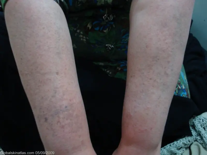 a minor to moderate case of lichen planus (LP) hyperpigmentation dermatitis on the forearms. The dermaititis bumps are dark purple and spead from the wrist to the elbow on the inside of both arms.