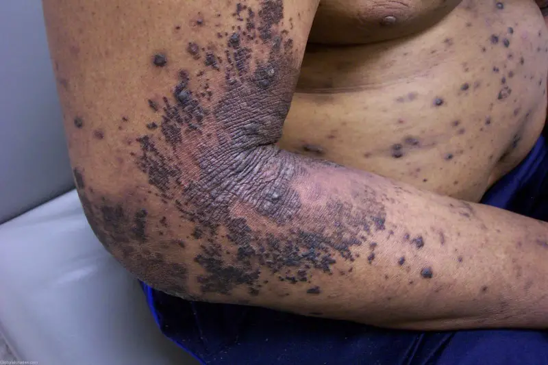 A prurtic eruption of lichen on the arm and trunk of an adult male. The papules are very clumped together and are deep purple in color.