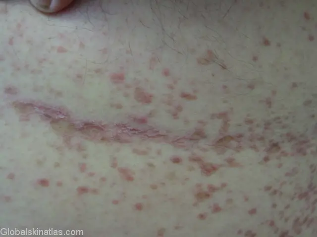 Lichenoid dermatitis in the groin area. Many red dots are seen within a skin fold of the groin area. The red inflammed dots are sporatic throughout the area.