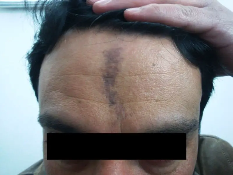 Lichenoid dermatitis on the forehead of an adult male. The eczema is dark purple and is in-between the eyebrows, and travels to the hair line.